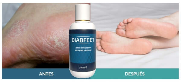 Diabfeet – What Is It & What Does It Serve for